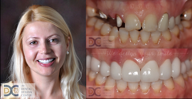 DDC%2Bveneers