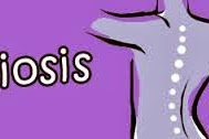 Scoliosis, Mild Ddd, Sciatica Hips & Mid Dorsum Pain. Add Together A Soft Latex Mattress Topper.