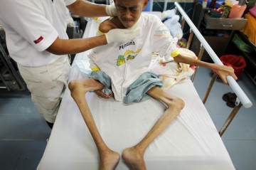 Foto-Foto Mengerikan Para Penderita HIV/AIDS | Taman Bacaan Online