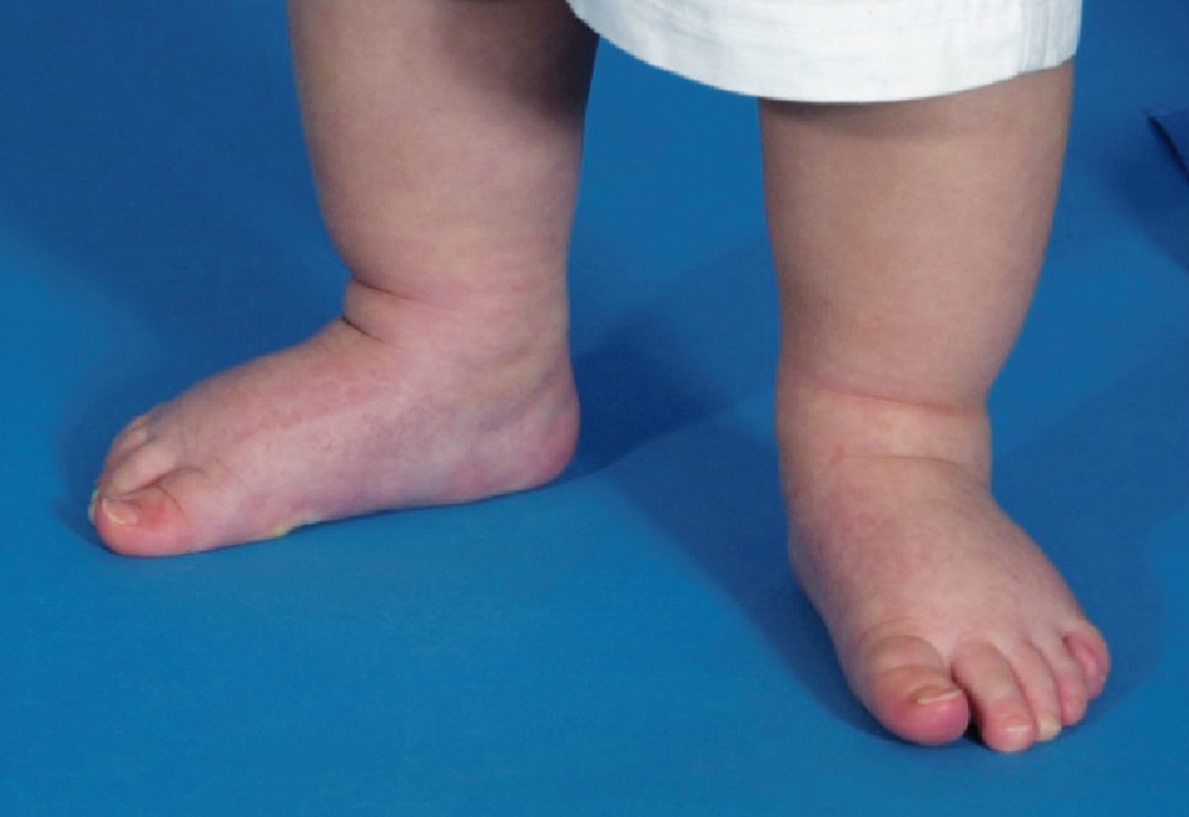 El Blog de Podologia PIE PLANO INFANTIL