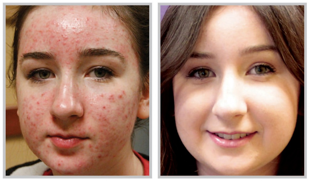 Acne Laser Skin Treatment Is This the Option You Are Looking For
