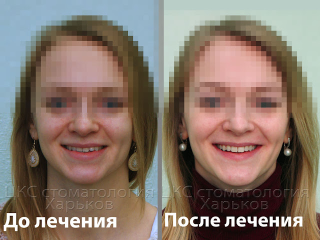 Неправильный прикус: 11 звезд, которые носили брекеты - фото до и после Здоровье