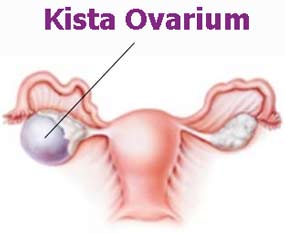 askep kista ovarium