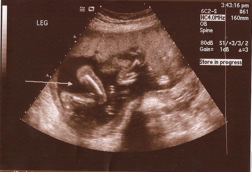 ERWIN FAMILY: 19/20 week ultrasound