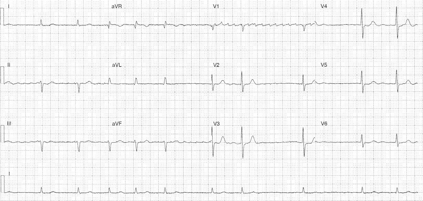 afib vs a flutter on ecg afib vs a flutter on ecg