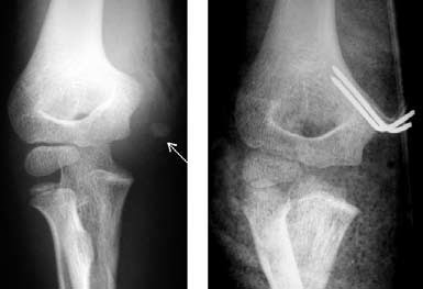 Figura 27. Fractura arrancamiento desplazada (flecha) de la epitróclea ...