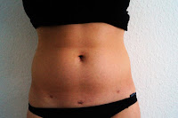 Zweigeteiltes Sesambein Sesamoiditis