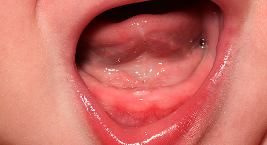 : Soulager les pouss?�es dentaires de b?�b?�