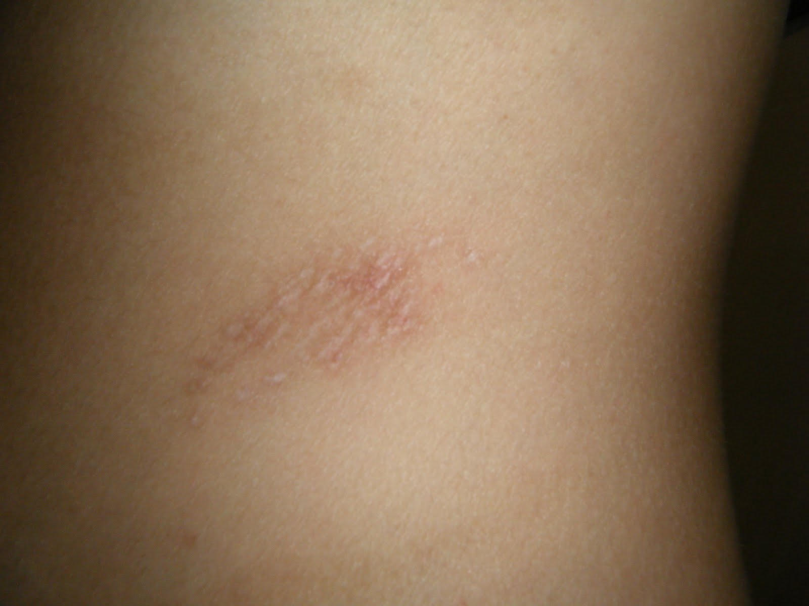 21 and Shingles Shingles scars