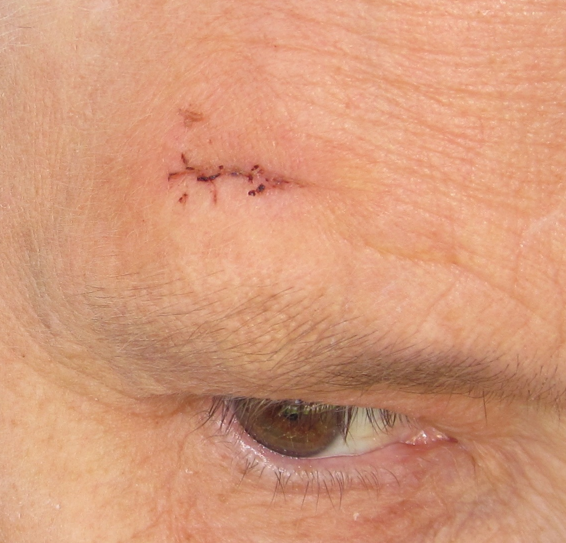 List 95+ Pictures Pictures Of Dissolvable Stitches In Mouth Excellent
