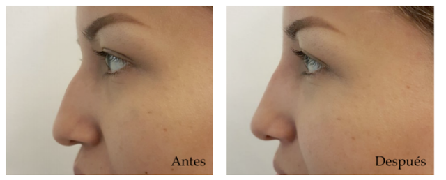 Rejuvenecimiento facial sin cirugía rejuvenecimiento-facial