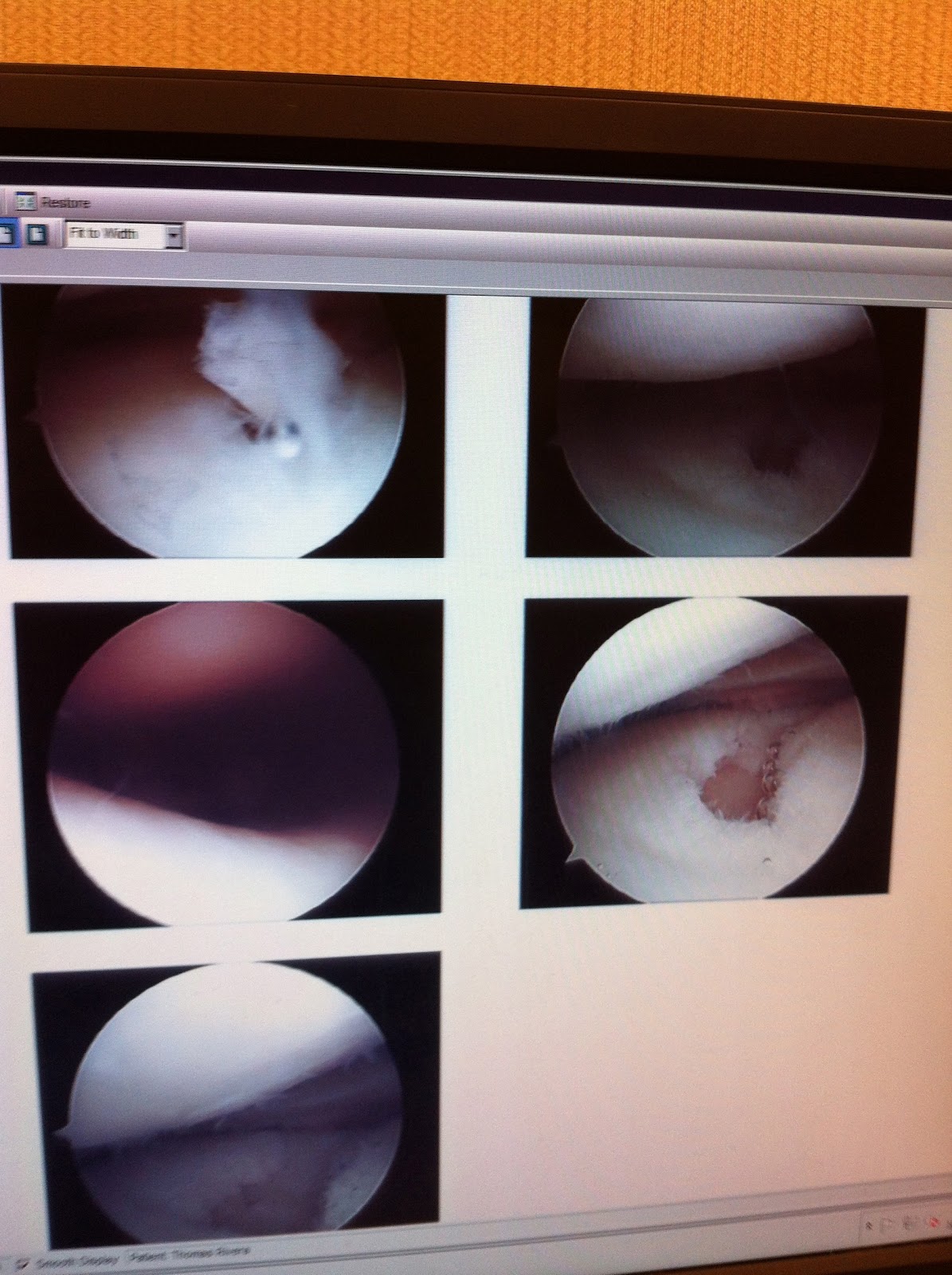 Athlete Interrupted Microfracture Surgery Explained