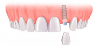 Thời gian cấy ghép răng implant bao lâu?