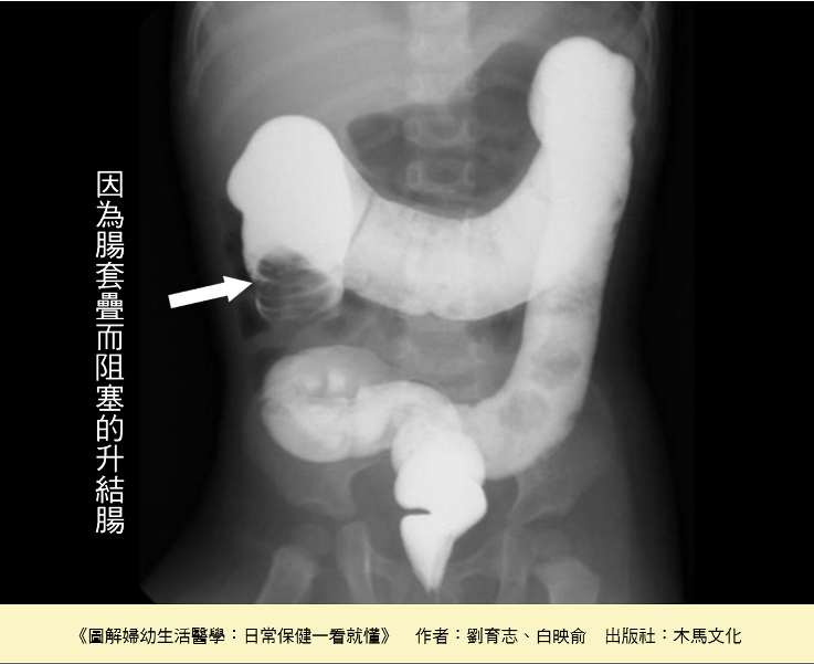 鋇劑灌腸可以診斷腸套疊