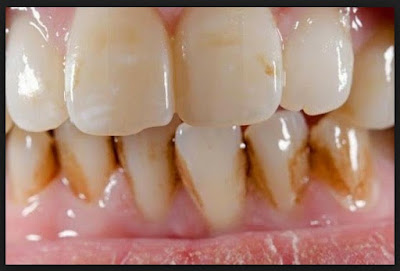 Buah Ini Dapat Menghilangkan Karang Gigi Buah Ini Dapat Menghilangkan Karang Pada Gigi