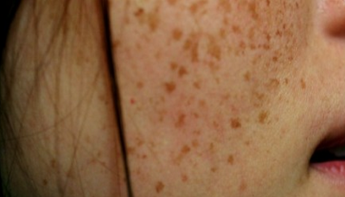 Leberflecken entfernen perfekt, 14 Hausmittel - Hautkrankheit