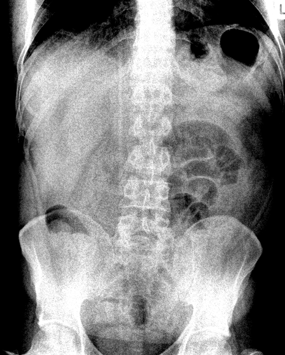 AppendicitisPlain Film Sumer's Radiology Blog