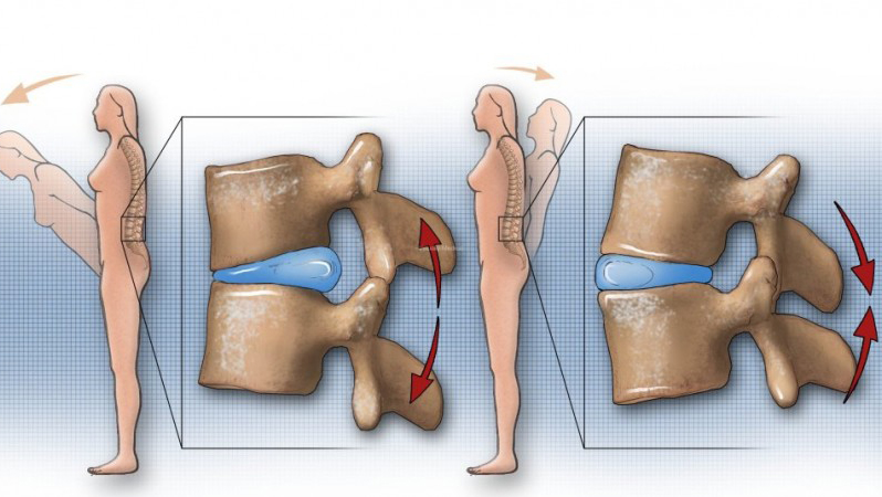 Nguyên nhân thoát vị đĩa đệm cột sống thắt lưng