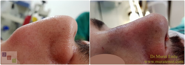 Nose Job Surgery For Men in Istanbul- Male Rhinoplasty in Istanbul - Men's Rhinoplasty in Istanbul - Nose Reshaping For Men in Istanbul- Mens Rhinoplasty in Turkey - Nose Job Rhinoplasty For Men in Istanbul - Nose Aesthetic for Men in Istanbul - Male Nose Operation in Turkey- Male Rhinoplasty Surgery in Istanbul - Male Rhinoplasty Surgery in Turkey - Male Nose Aesthetic Surgery - Rhinoplasty In Mens Istanbul