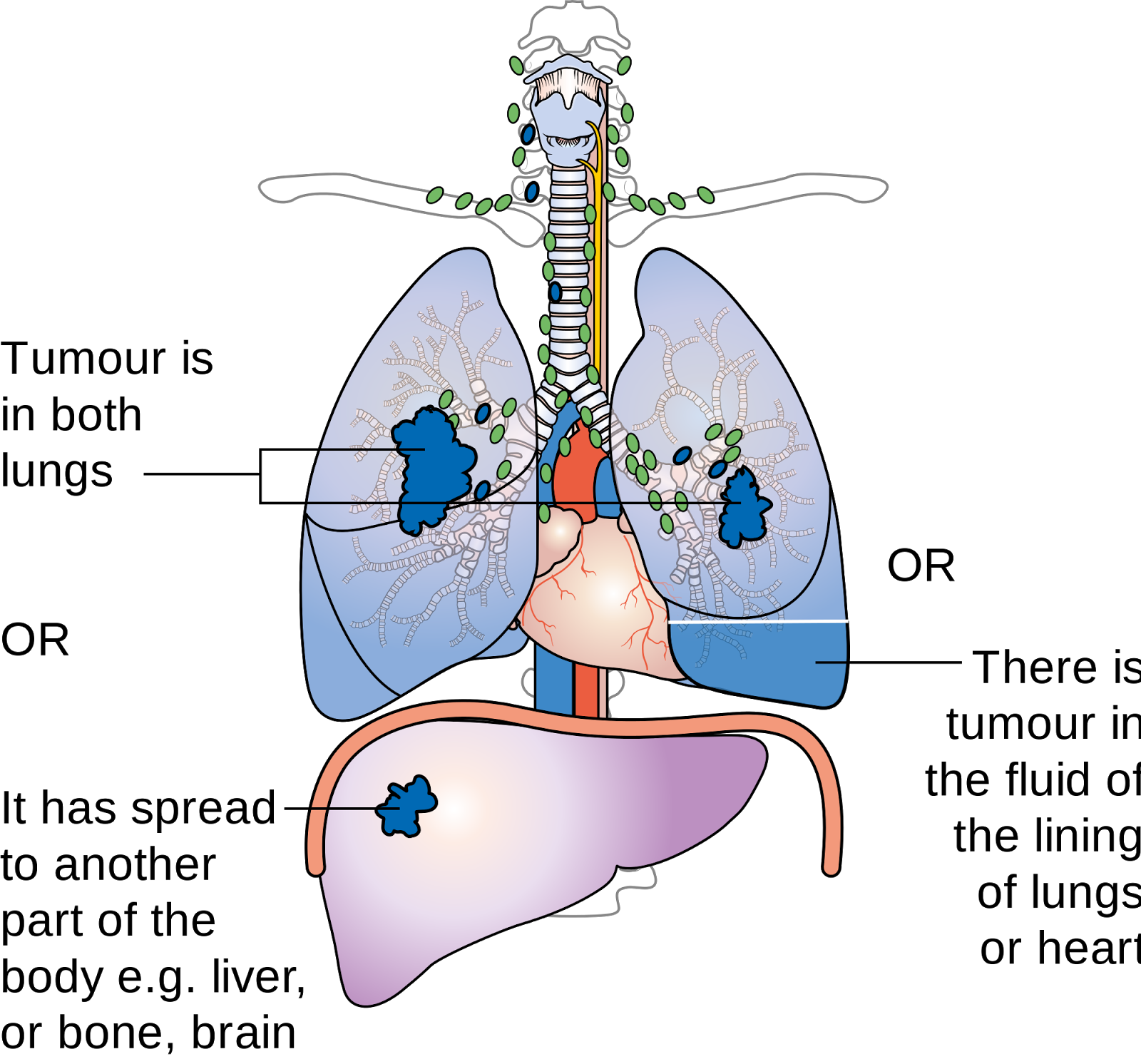 lung cancer what is cancer prostate cancer pancreatic cancer