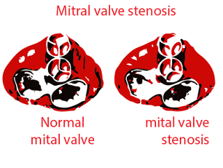 Rheumatic fever