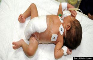 Bayi Berkaki 6 Lahir di Pakistan