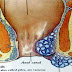 obat wasir herbal thumbnail