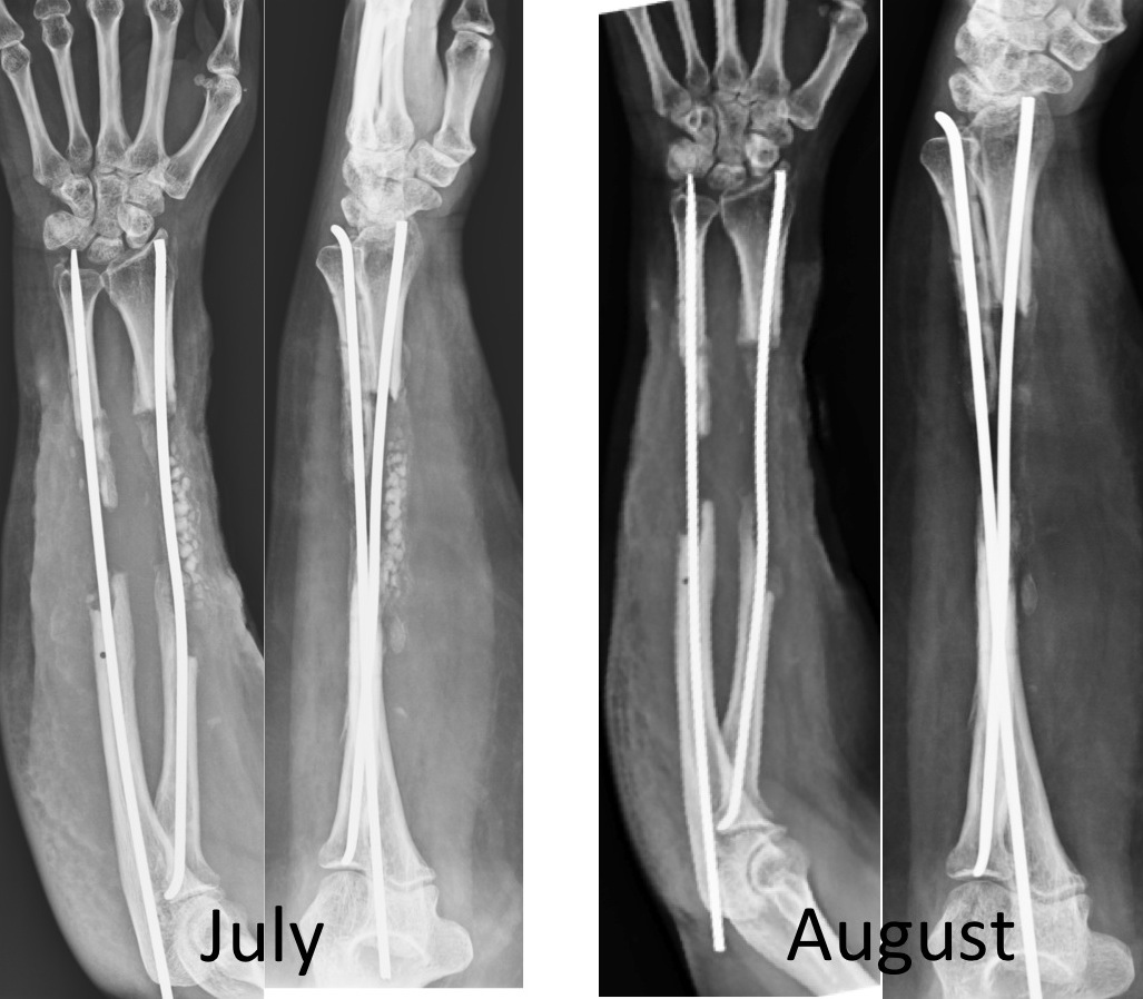 Interesting Case Studies from www.ilizarov.in: Case 3 - Infected ...