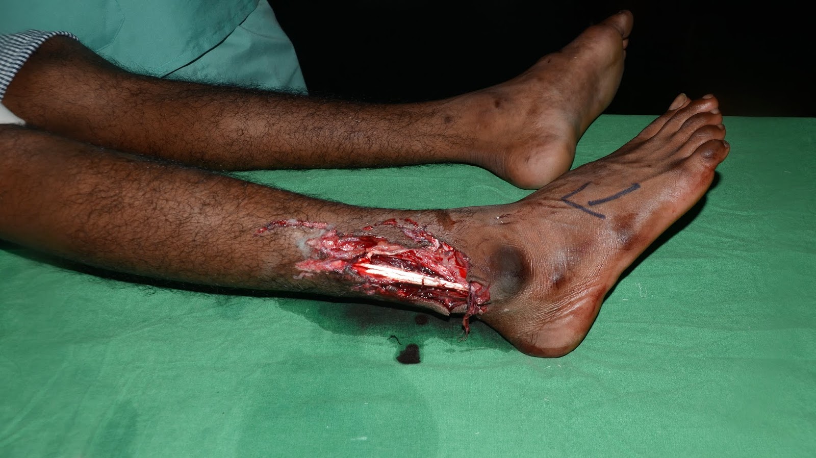 CRUSH INJURY FOOT, LOWER LIMB INJURIES AND LIMB SALVAGE: CRUSH INJURY LEG -  MICROVASCULAR FREE GRACILIS MUSCLE FLAP AND SKIN GRAFTING - OUTCOME
