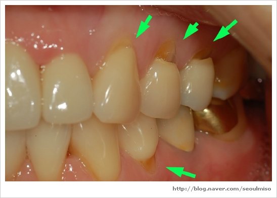 tooth brush abrasion if you see this on your teeth you need to go