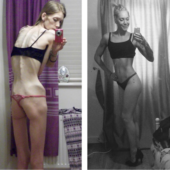 Anorexia Gallery Pictures 102