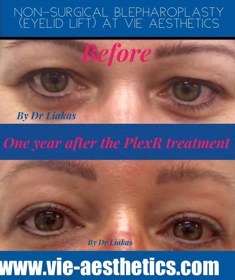 Non Surgical Eye Lift