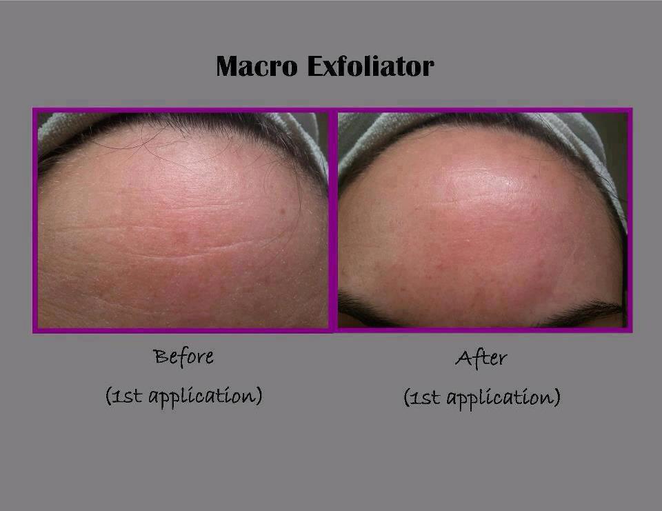 Movie Star Skin R+F MacroExfoliator Tool