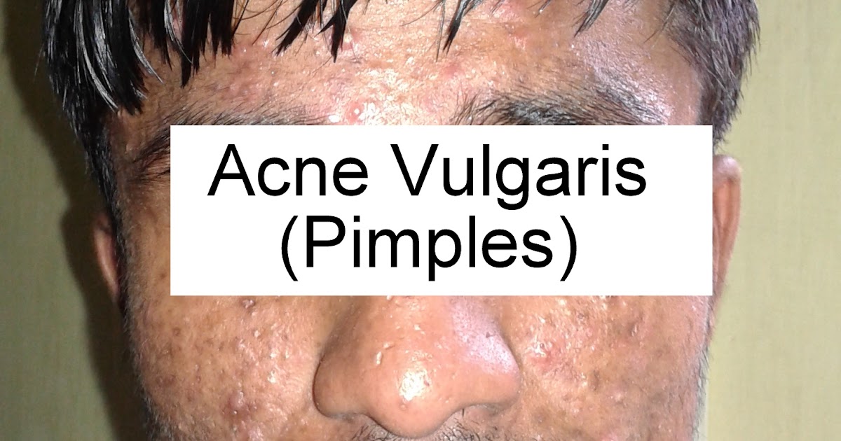 Best medicines for Pimples or Acne avilable in the market.