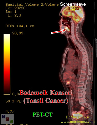 Bademcik kanseri - PET / BT - PET / CT - Tonsil cancer