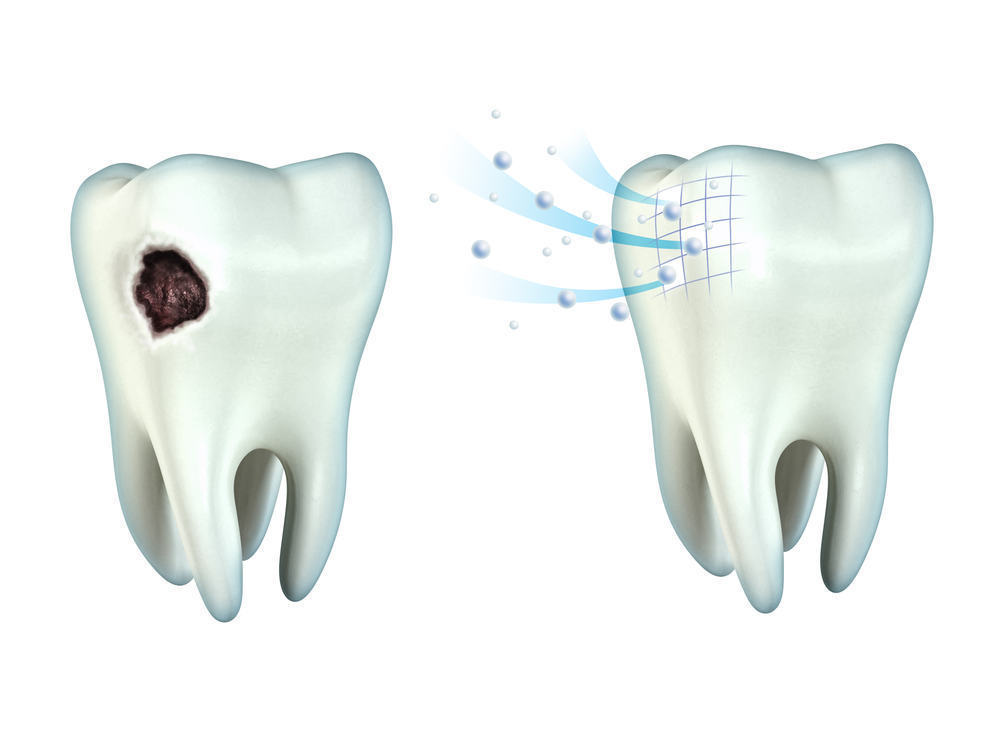 Or if the tooth has decayed and is damaged, tooth extraction needs to be do...