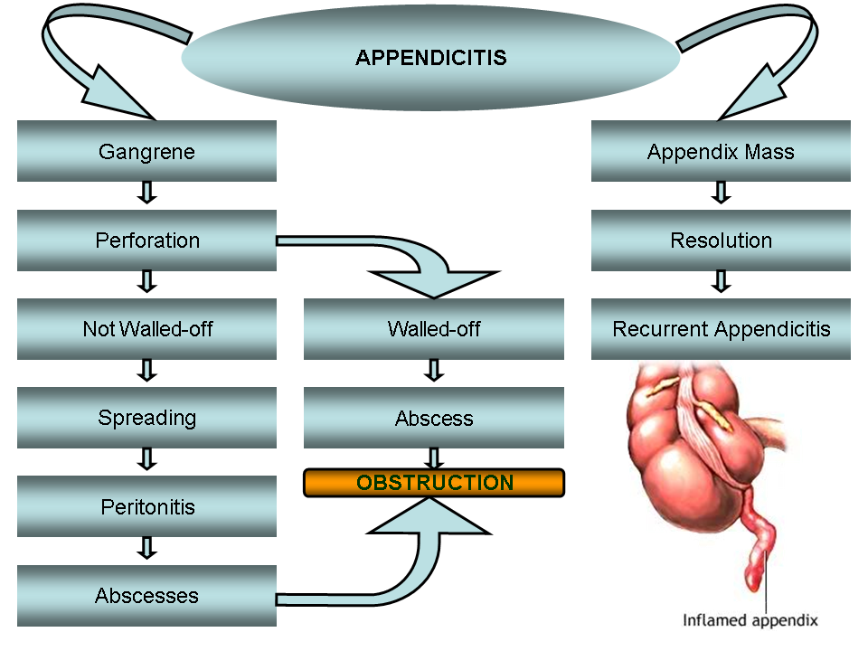 Differential Diagnosis Of Appendicitis Conditions Con - vrogue.co
