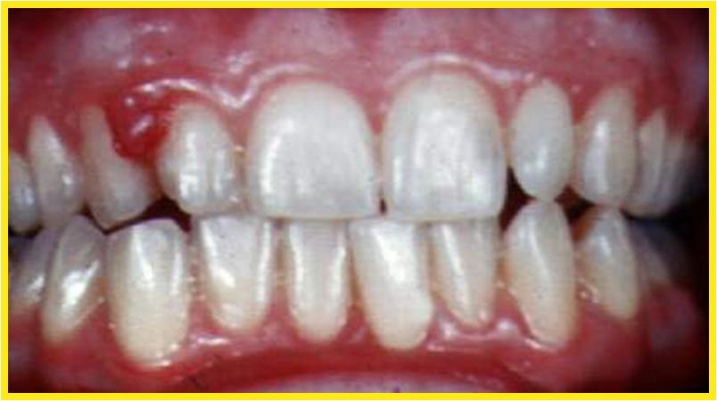 Dentistry lectures for MFDS/MJDF/NBDE/ORE: Images and Description Of