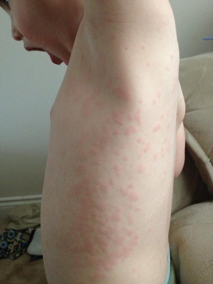 5ths disease rash pictures