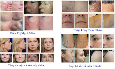 Trước Và Sau Sử Dụng Máy Triệt Lông Giá Rẻ HS 965 Trước Và Sau Sử Dụng Máy Triệt Lông Giá Tốt HS 965