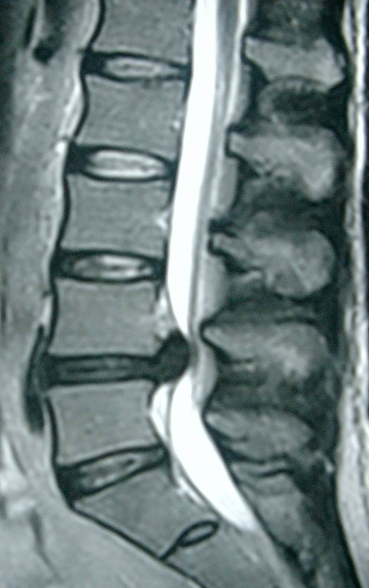 Acupuncture and Rehabilitation ( Road to full recovery) Lumbar