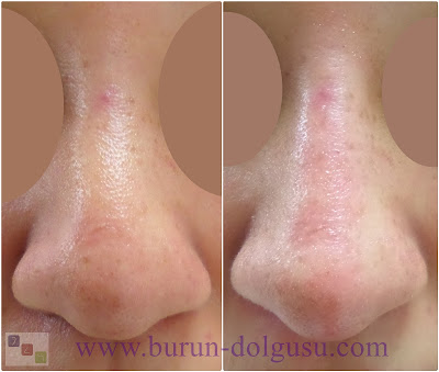 Non-surgical nose job - Non surgical nose job with filler in İstanbul - Non-surgical rhinoplasty in İstanbul - Nose tip filler augmentation in İstanbul - Non-surgical rhinoplasty in İstanbul - Nose filler injection in Turkey - The 5 Minute Nose Job in İstanbul, Turkey - Non-surgical nose job in Istanbul - Non-surgical nose job istanbul - Nose filler injection Turkey - Injectable nose job - Liquid rhinoplasty