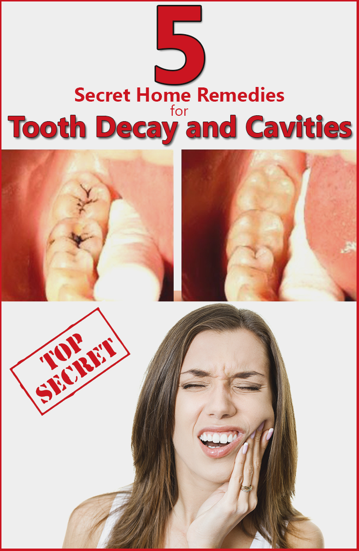 5 Secret Home Remedies for Tooth Decay and Cavities Natural Tooth 