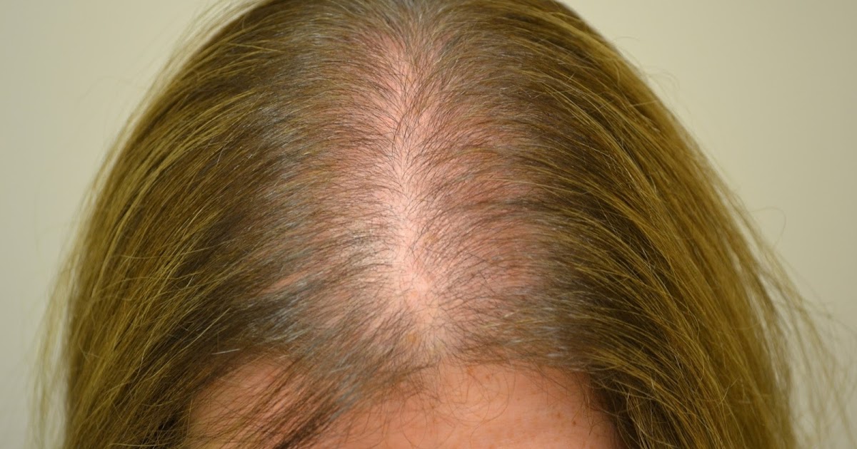 Выпадение волос головы причина лечение. Диффузная телогеновая алопеция. Андрогензависимая алопеция. Очаговая (гнездная) алопеция.