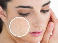 Cara Alami Merawat kulit Wajah Yang Kering Cara Alami Merawat kulit Wajah Yang Kering