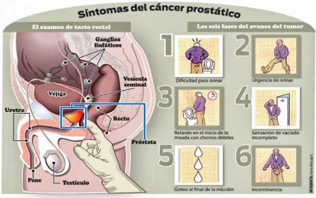 ¿cuánto dura el cáncer de próstata de t1 a t2 pro pubg
