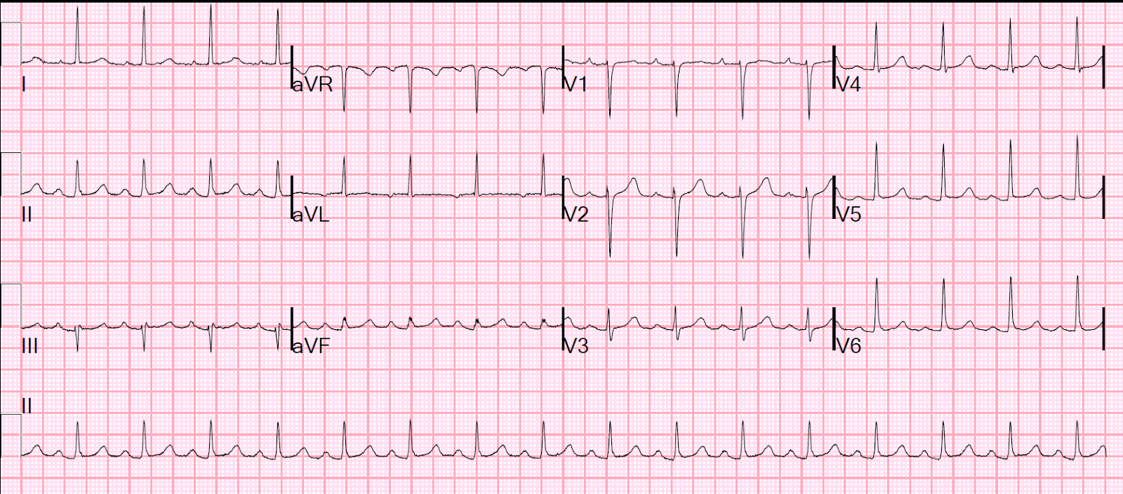 Isoptin Dose In Svt
