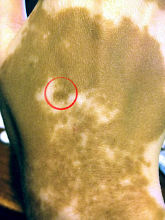 Me and My Vitiligo: Can you SPOT the difference?