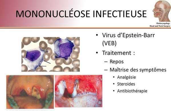 Mononucléose infectieuse : fatigue, fièvre, maux de tête