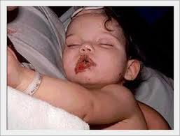 Obat Salep Herbal untuk Herpes di Bibir Balita